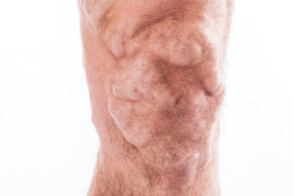 Chronic Venous Insufficiency