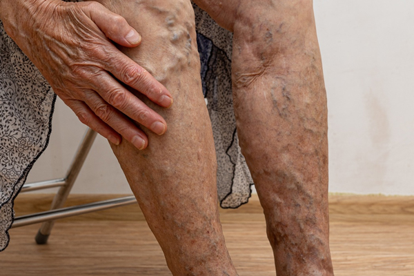 vein-center-columbus-polaris-leg-ulcers.jpg
